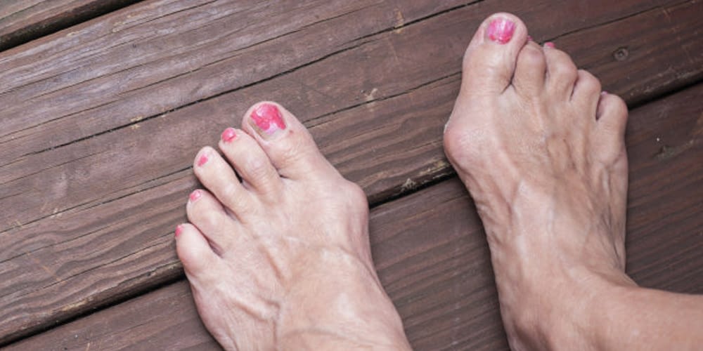 Alta Ridge Foot Specialists Bunions